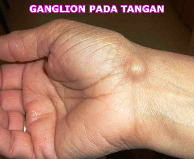 ganglion pada tangan